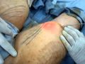 شفط الدهون بالليزر-liposuction by laser