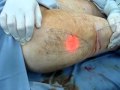 liposuction by laser-شفط الشحوم بالليزر±