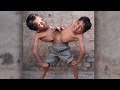 توأم متصل.. يرفض الانفصال!