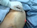 laser,liposuction,creation of body image,شفط الدهون-نحت الجسم