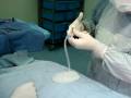 saline filled breast augmentation-implants,silicone-تكبير الثدي بالماء والملحï¿½