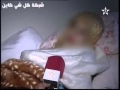 ولادة نادرة لتوأم سيامي